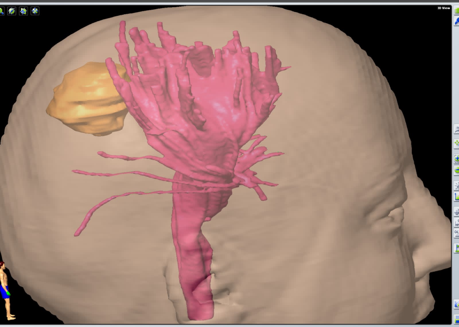 المستشفى التخصصي يجري عملية جراحية نوعية لاستئصال ورم حميد في جذع الدماغ باستخدام نظام الملاحة
