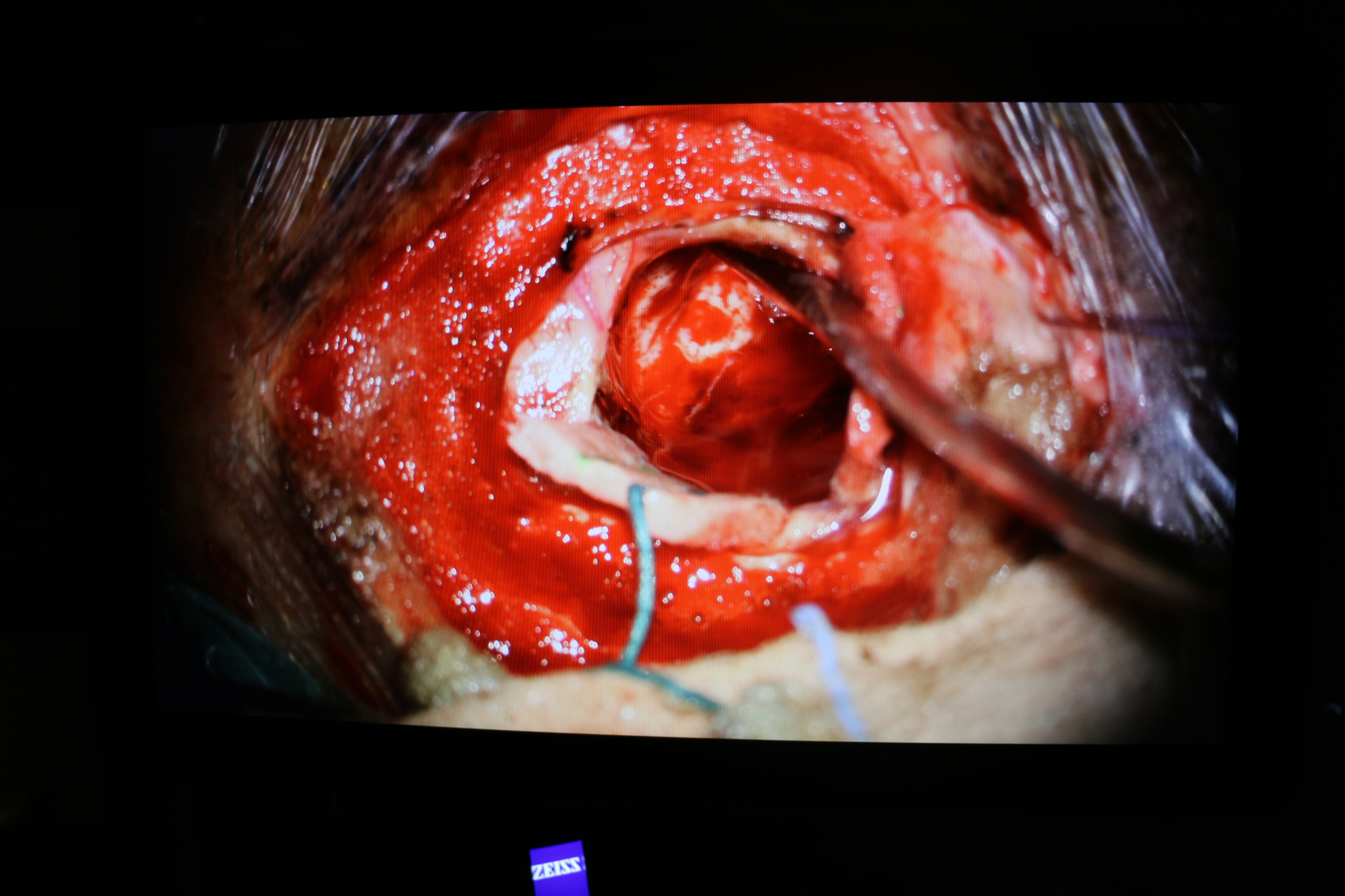 لأول مرة في القطاع الخاص بالأردن استئصال ورم دبقي في الدماغ باستخدام تقنية  5-ALA وجهاز الملاحة في المستشفى التخصصي