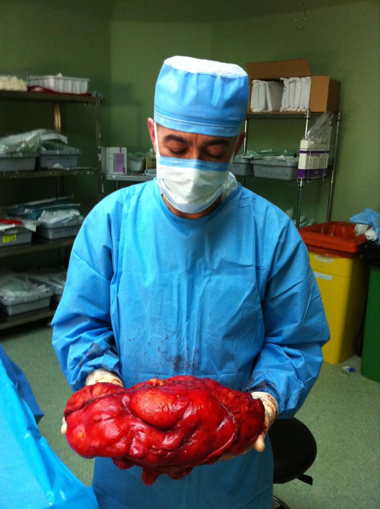 استئصال ورم دهني كبير من التجويف البطني لمريض عراقي في المستشفى التخصصي