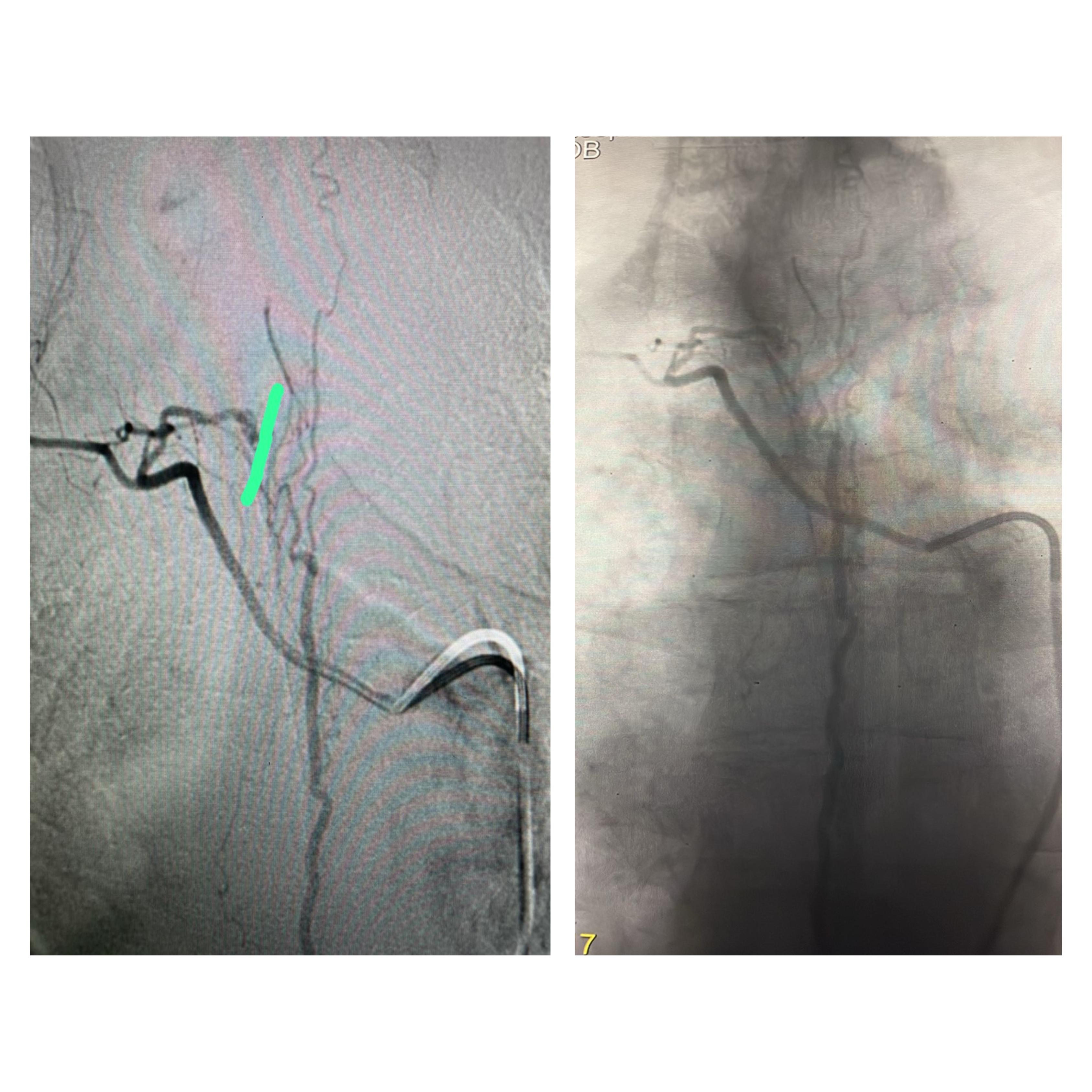 لأول مرة  في المستشفى التخصصي: معالجة شلل طرفي ناتج عن تشوه شرياني وريدي في النخاع الشوكي