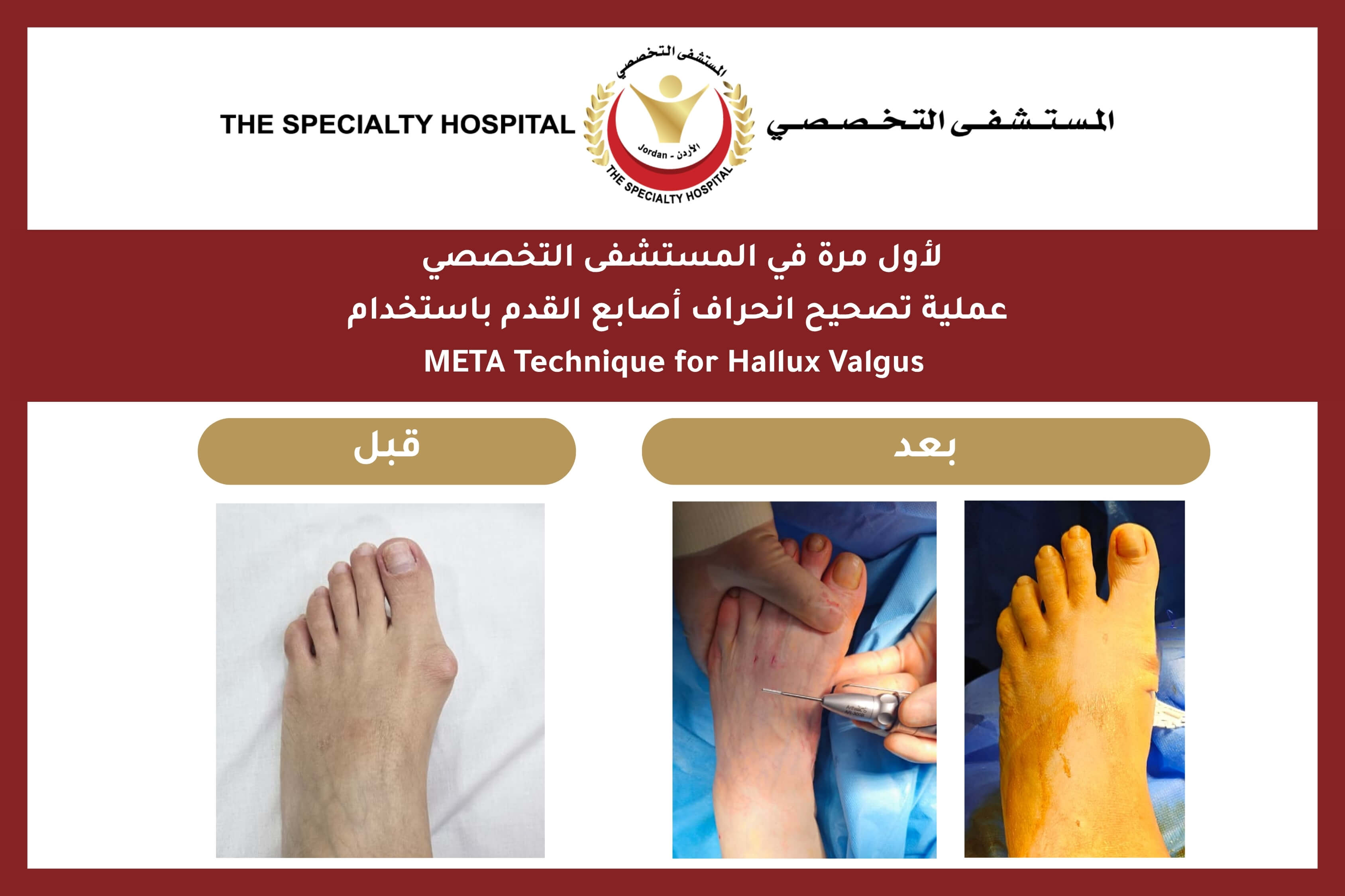 لأول مرة في المستشفى التخصصي عملية تصحيح انحراف أصابع القدم باستخدام META Technique for Hallux Valgus 
