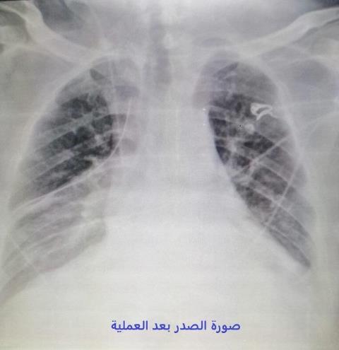 نجاح عملية نادرة لإصلاح فتق الحجاب الحاجز واعادة محتويات البطن الى مكانها في المستشفى التخصصي