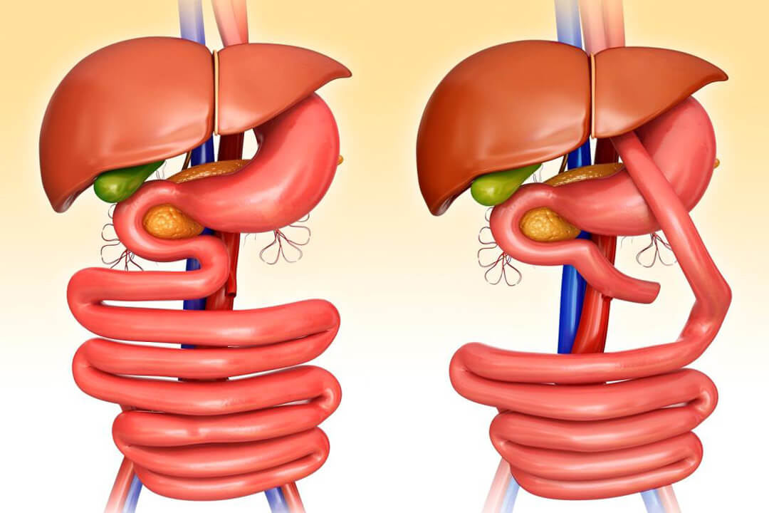 Laparoscopic Gastric Bypass Surgery