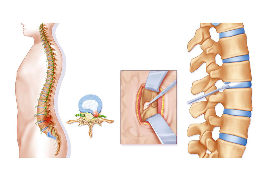 Disc Surgery