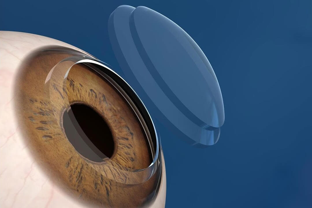 The unit of corneal transplantation